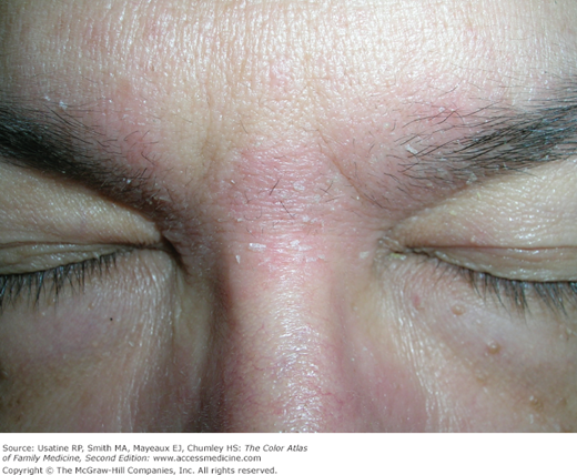 Eczema On Eyebrows