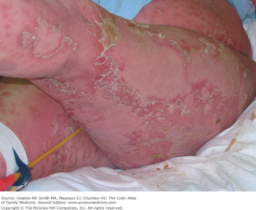 Erythroderma secondary to toxic shock syndrome.