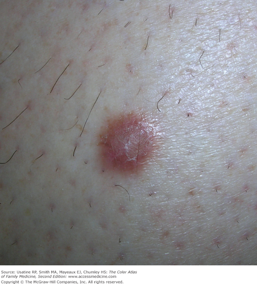 Dermatofibrome Verhalten Fibrom Stielwarze Dermatofibrom MRFBK Dermatofibrome Verhalten Fibrom Stielwarze Dermatofibrom MRFBK