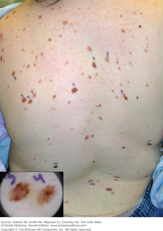 Dysplastic Nevus | Basicmedical Key