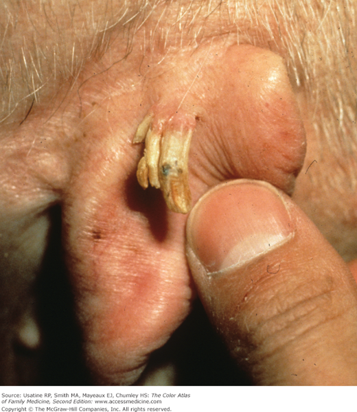 actinic keratosis horn