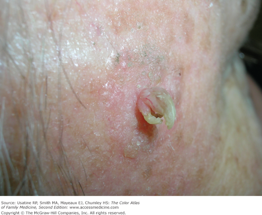 actinic keratosis horn