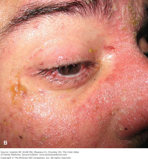 Erythema Multiforme Stevens Johnson Syndrome And Toxic Epidermal