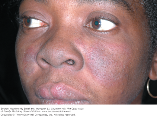 Lupus Systemic And Cutaneous Basicmedical Key
