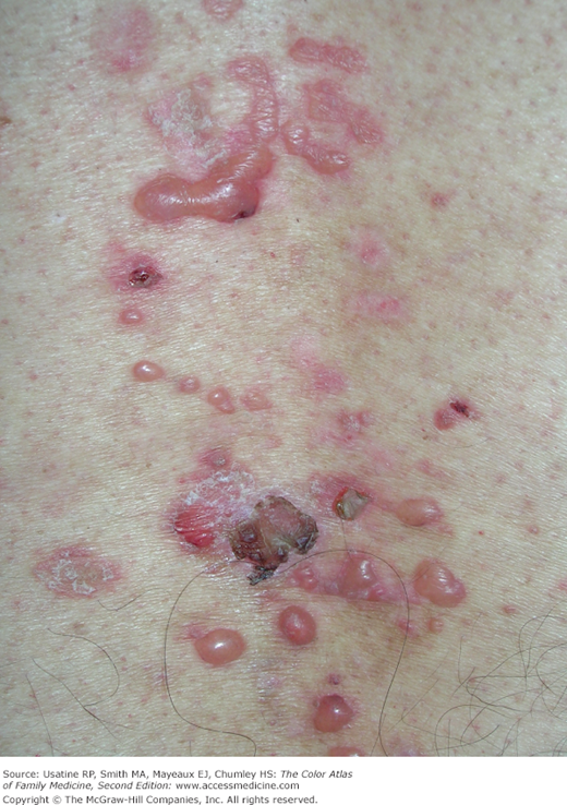 Bullous Pemphigoid | Basicmedical Key