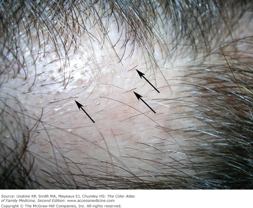 Alopecia Areata | Basicmedical Key