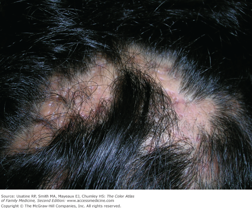 folliculitis scalp african american