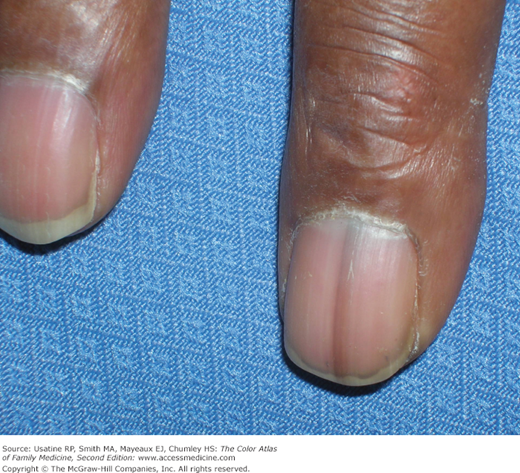 Diagnosing nail unit melanomas at a faster clip