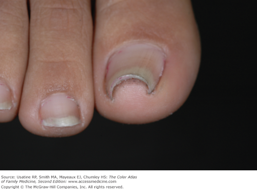 Pincer nail deformity - Stock Image - C056/4975 - Science Photo Library