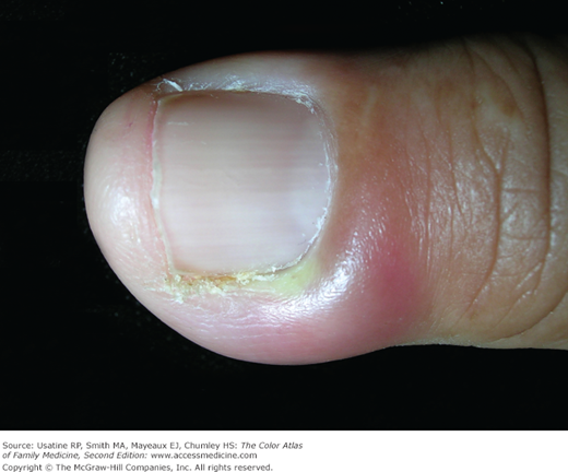 Paronychia Skin Infection Acute And Chronic Familydoctor Org - kulturaupice