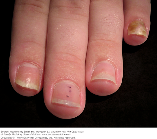 Nail Psoriasis & its Management - By Dr. Nitin Hundre | Lybrate