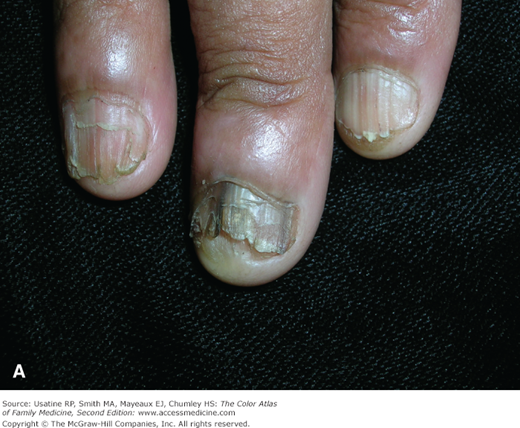 Man, 45, With Greasy Rash and Deformed Nails | Clinician Reviews