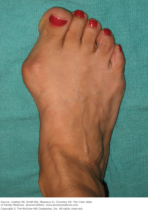 Bunion Deformity | Basicmedical Key