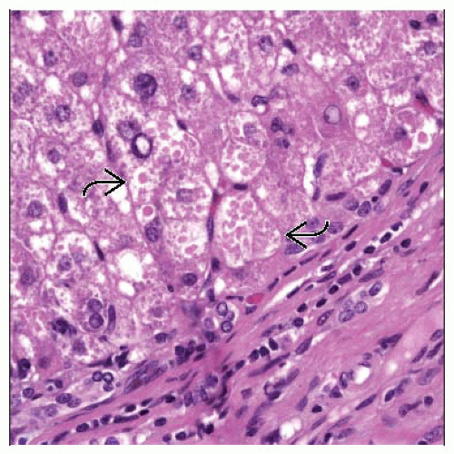 Alpha-1-Antitrypsin Deficiency | Basicmedical Key