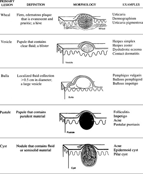 macule vs papule