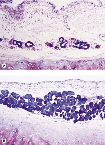 chronic bronchitis histology