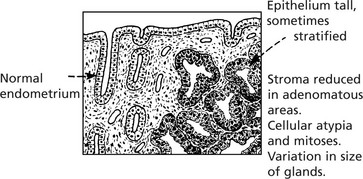 Hyperplasia and atypical hyperplasia