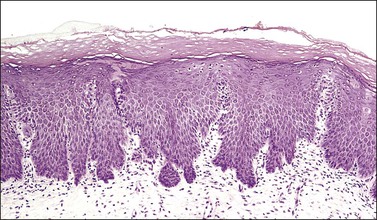 cervix transformation zone histology