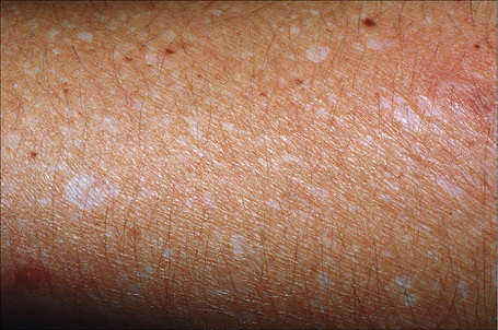 Idiopathic Guttate Hypomelanosis African American Idiopathic Guttate Hypomelanosis African American