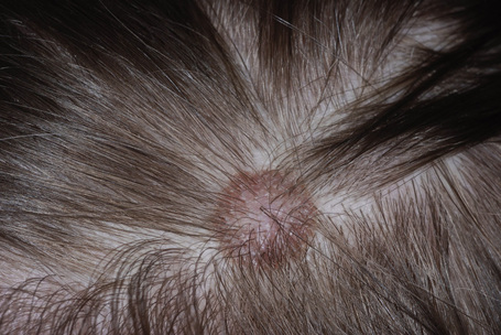congenital nevus scalp