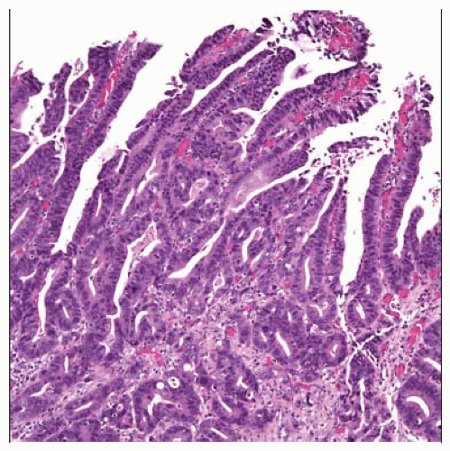 papilloma bile duct