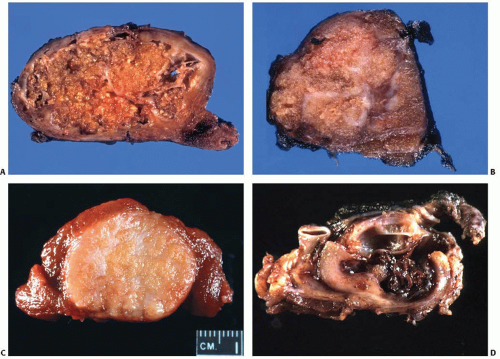 papillary thyroid carcinoma gross
