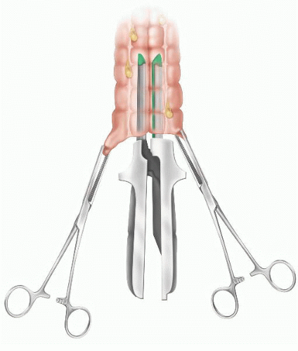 Transverse Colectomy: Open Technique | Basicmedical Key