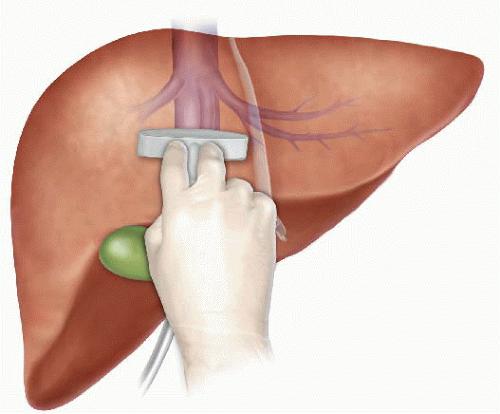 Resultado de imagem para intraoperative ultrasound liver