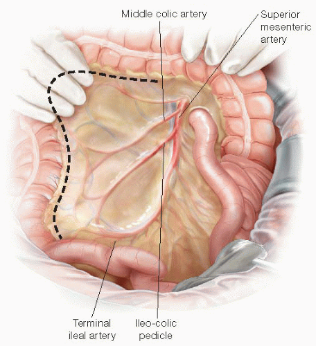 Anatomy of ileal pouch anal anastomosis (IPAA). Patients who