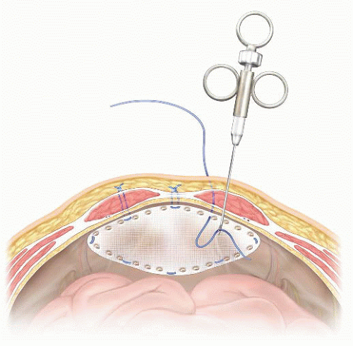 Appendectomy: Open Technique | Basicmedical Key