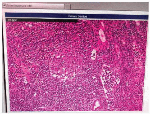 Sentinel Lymph Node Biopsy For Breast Cancer | Basicmedical Key