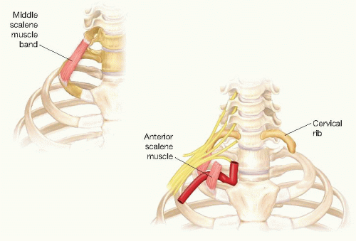Venous And Arterial Thoracic Outlet Syndrome Basicmedical Key