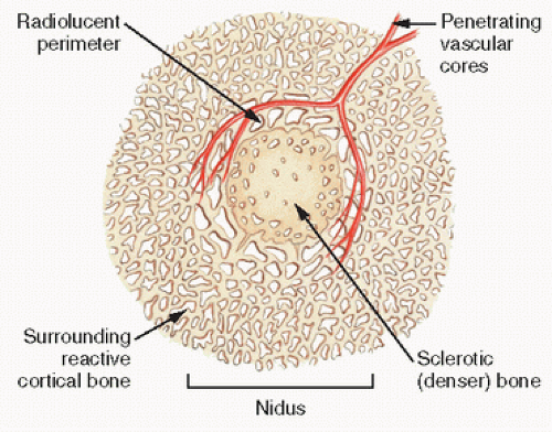 osteoid osteoma histology