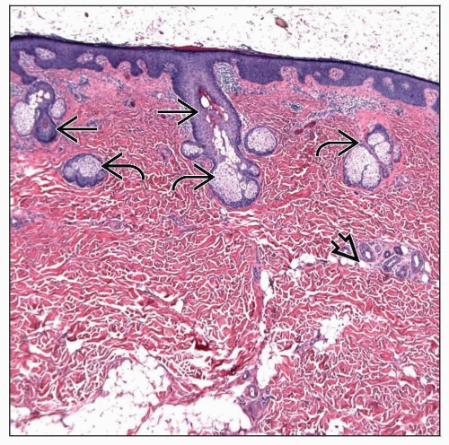 Dermoid Cyst | Basicmedical Key