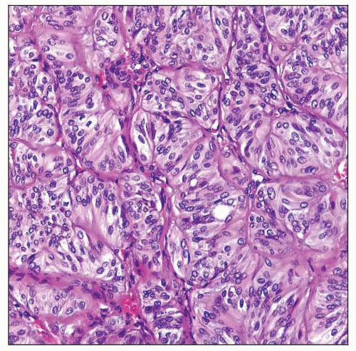 Hyalinizing Trabecular Tumor | Basicmedical Key