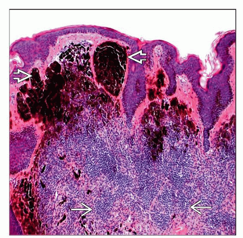 Congenital Melanocytic Nevi Basicmedical Key