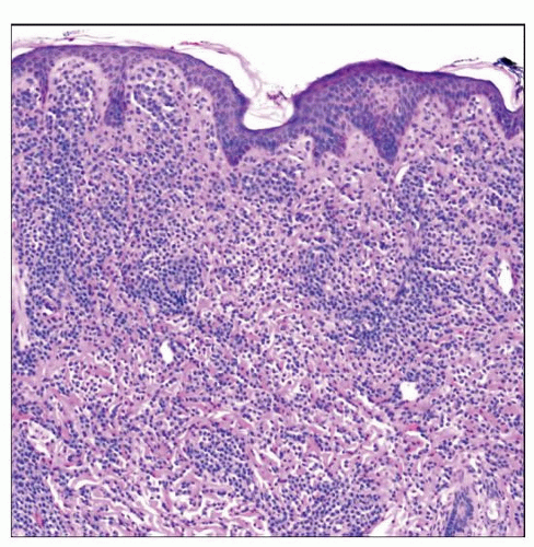 Cutaneous And Systemic Mastocytosis Basicmedical Key