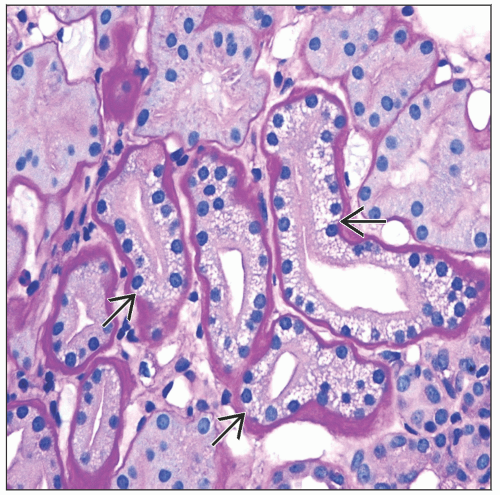 Calcineurin Inhibitor Toxicity | Basicmedical Key