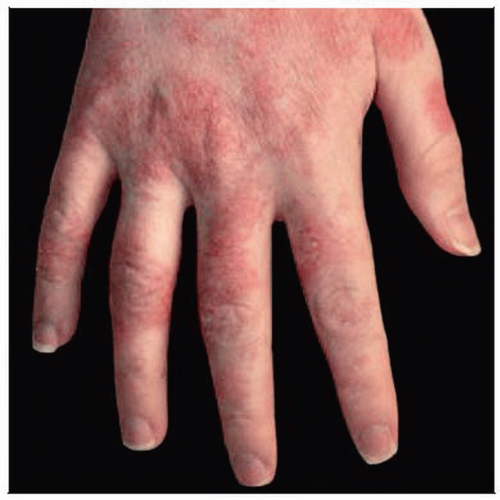 All 104+ Images pictures of contact dermatitis on hands Latest