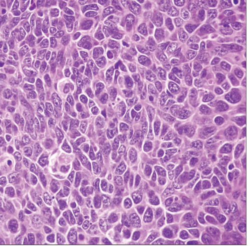 overview-of-malignant-epithelial-neoplasms-of-the-lung-basicmedical-key