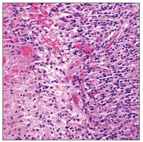 Feline cutaneous lymphoma. Figure 1. Diffuse anaplastic 