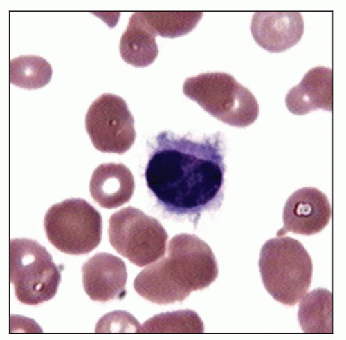 Hairy Cell Leukimia 18