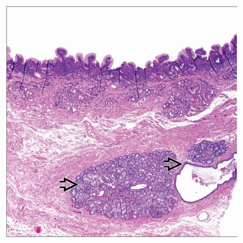 carditis-basicmedical-key