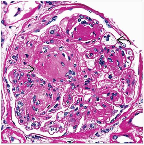 Diabetic Nephropathy Histology