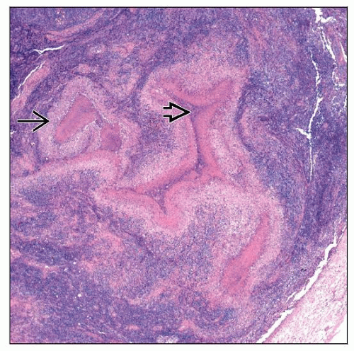 Granuloma Venereum