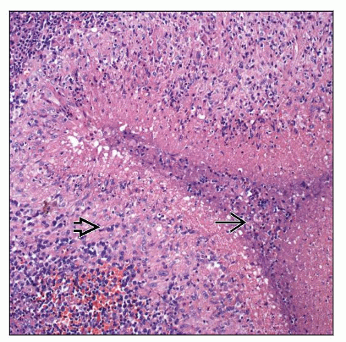 Granuloma Venereum