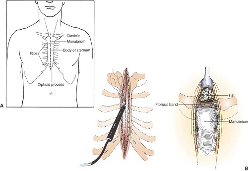 Median Sternotomy