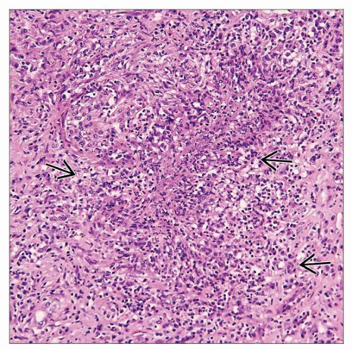Granulomatosis With Polyangiitis Wegener Basicmedical Key