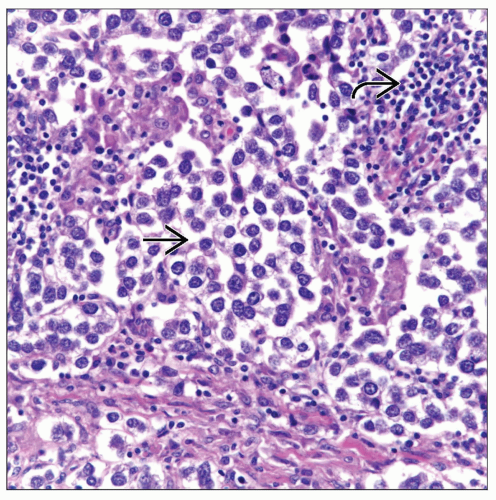 mediastinal-seminoma-basicmedical-key