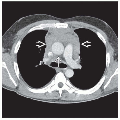 hodgkin-lymphoma-of-the-mediastinum-basicmedical-key